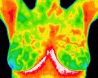 3- Normal thermal pattern.jp2