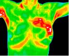 4- Ductal Carcinoma in situ (DCIS) in upper left breast.jp2