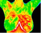 6- Fibrocystic changes in left breast.jp2