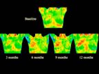8- This cancer (DCIS) was not detectable by mammogram until final image.jpg