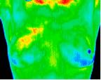 10- Small DCIS in upper right breast.jp2