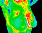 13- Cancer, DCIS (2 of 3 of this study) medial left breast.jp2