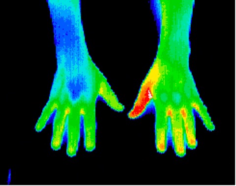 Chronic right carpal tunnel syndrome