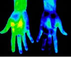 8- Reflex sympathetic dystrophy left hand.jp2