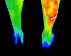 3- Stress fracture right ankle.jp2