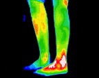 4- Poorly healed left ankle fracture.jp2