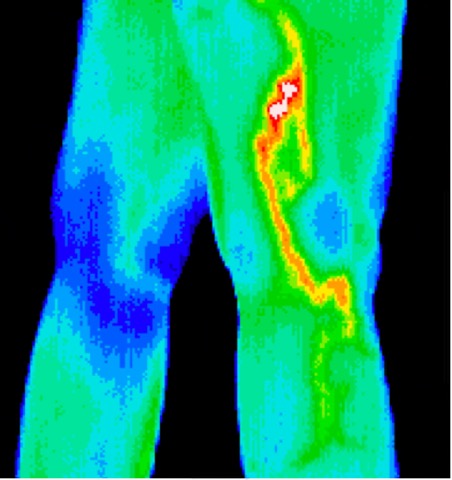 Phlebitis